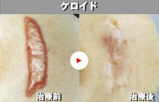 切らないケロイドレーザー治療 あきらめていた方も自分一人で悩まずに思い切ってご相談ください 精美スキンケアクリニック 美容皮膚科 美容外科