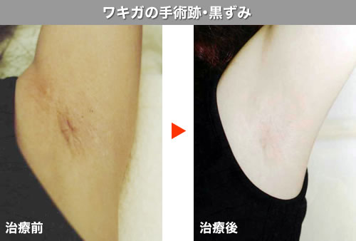 切らない妊娠線 肉割れ キズ跡 ケロイド 手術跡 精美スキンケアクリニック 美容皮膚科 美容外科