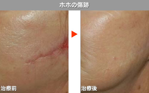 消す 肉 割れ 肉割れを消すには炭酸ガス！3つの効果と自宅でできる方法とは？