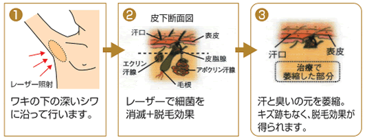 ワキガ を 治す 方法